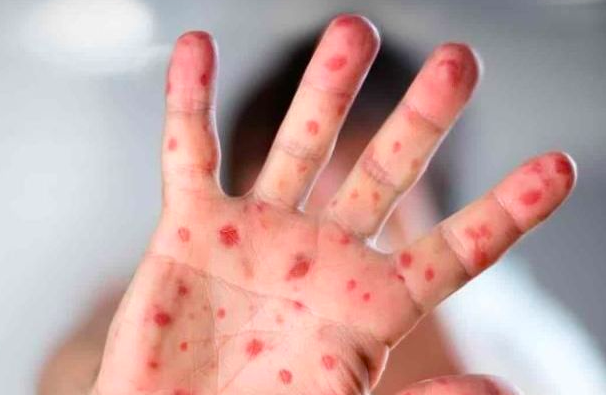 La viruela del mono se esparce por Europa y su regulador médico busca soluciones urgentes