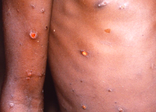 AUTORIDADES DE SALUD EMITE ALERTA SANITARIA POR “VIRUELA DEL MONO”