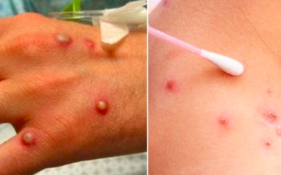 En el PEF 2023 se deben garantizar recursos para la compra de vacunas contra la viruela símica