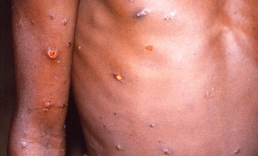 NIÑOS MENORES DE 8 AÑOS EN ALTO RIESGO DE CONTRAER EL VIRUS DEL MONO