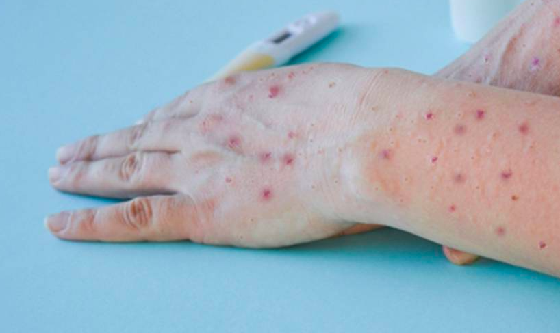 ALERTA SANITARIA POR LOS 3 MIL CASOS DE VIRUELA DEL MONO ACUMULADOS; VAN 6 MUERTOS