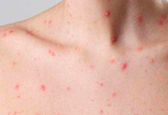 VIRUELA DE ALASKA ACTIVA EMERGENCIA TRAS REGISTRARSE LA PRIMERA VÍCTIMA MORTAL EN EU