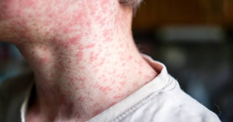 SE REGISTRAN NUEVE MUERTES EN EL PAÌS POR SARAMPIÓN Y MÁS DE 2 MIL CONTAGIOS