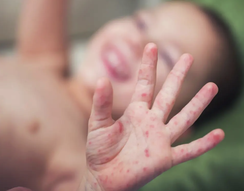 DISMINUYE BROTE DE SARAMPIÓN EN EL NORTE DEL PAÍS, PERO TODAVÍA NO SE PUEDE CANTAR VICTORIA: SSA