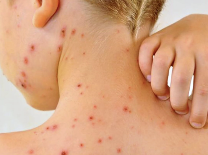 ACORRALAREMOS AL VIRUS DEL SARAMPIÓN CON VACUNAS Y CONTROL EPIDEMIOLÓGICO: IMSS-BIENESTAR