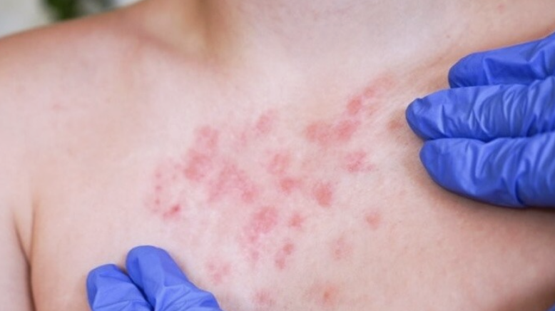 VACUNACIÓN LOGRA FRENAR CONTAGIOS DE SARAMPIÓN; HAY 30% MENOS CASOS ACTIVOS: SSA